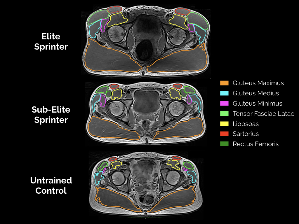 Three MRI images of hip muscles. 